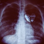 Рентген сердца, расколовшегося на две части